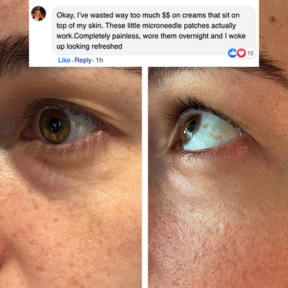 Nuvia™  Dissolving Micro needle Eye Patches